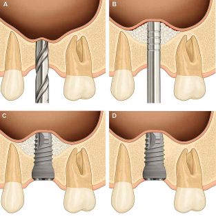 Schematische Darstellung des internen Sinuslifts: Anhebung des Kieferhöhlenbodens mit Knochenersatzmaterial über den Implantatkanal