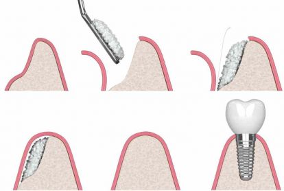Schematische Darstellung der lateralen Augmentation: Verbreiterung des Kieferkamms mit Knochenersatzmaterial vor der Implantation