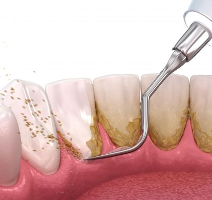3D-Grafik mit Zahnsteinablagerungen und Instrument zur professionellen Zahnreinigung – Darstellung des Behandlungsablaufs im Zahnzentrum Dr. Parusel & Kollegen