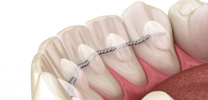 Festsitzender Retainer hinter den Frontzähnen nach abgeschlossener kieferorthopädischer Behandlung zur Langzeitstabilisierung