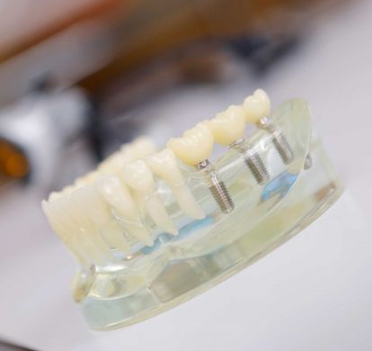 Moderne Zahnimplantate im Zahnzentrum Dr. Parusel & Kollegen in Salzgitter